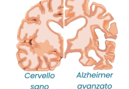 Giornata mondiale dell’Alzheimer: la diagnosi precoce può fare la differenza